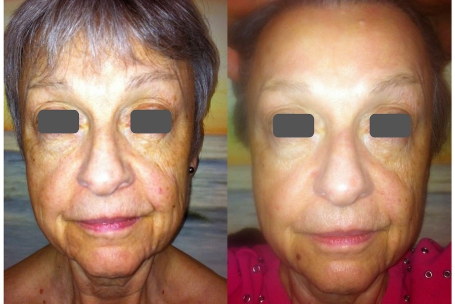 Before After facelift photo