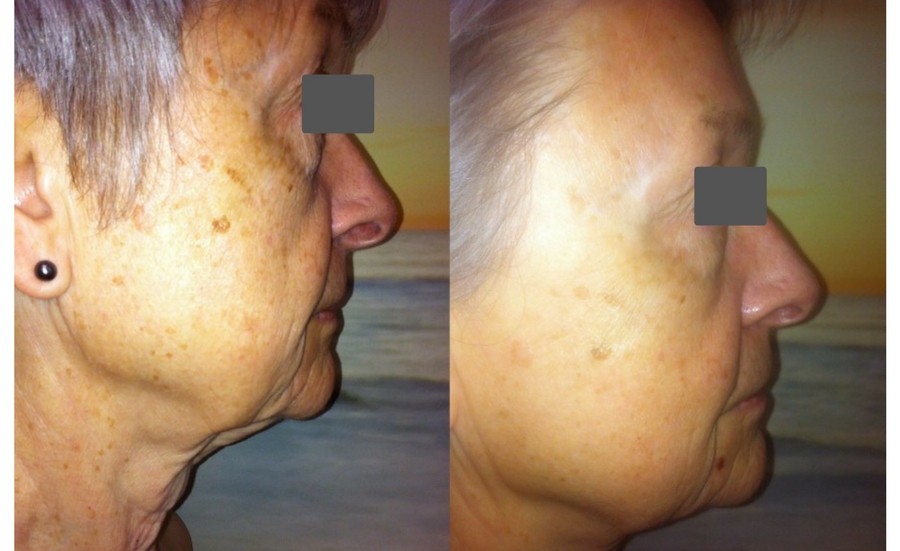 Before and After Jade Rejuvenating Non-Surgical Facelift